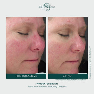 Jan Marini – Rosalieve Redness Reducing Complex (30ml)