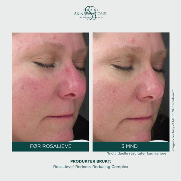 Jan Marini – Rosalieve Redness Reducing Complex (30ml)