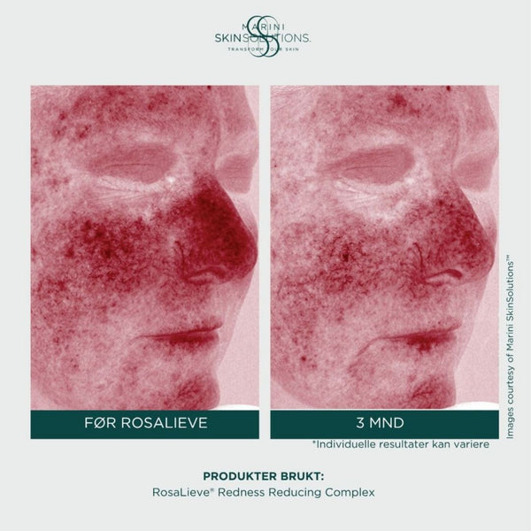 Jan Marini – Rosalieve Redness Reducing Complex (30ml)